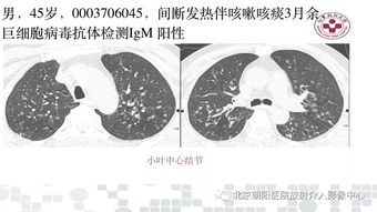 得甲流一周變成病毒性肺炎